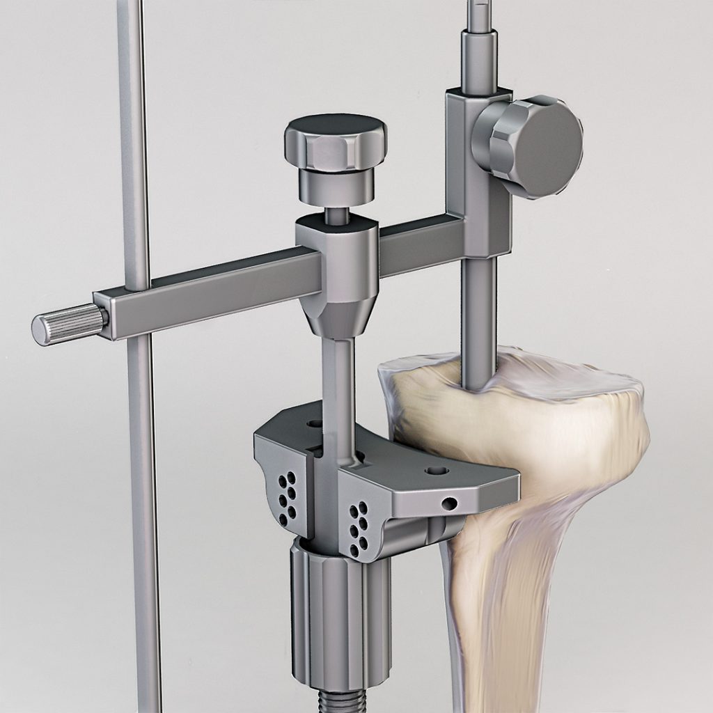 DGO3D Serf Images 3D Prothèse Médicale 2