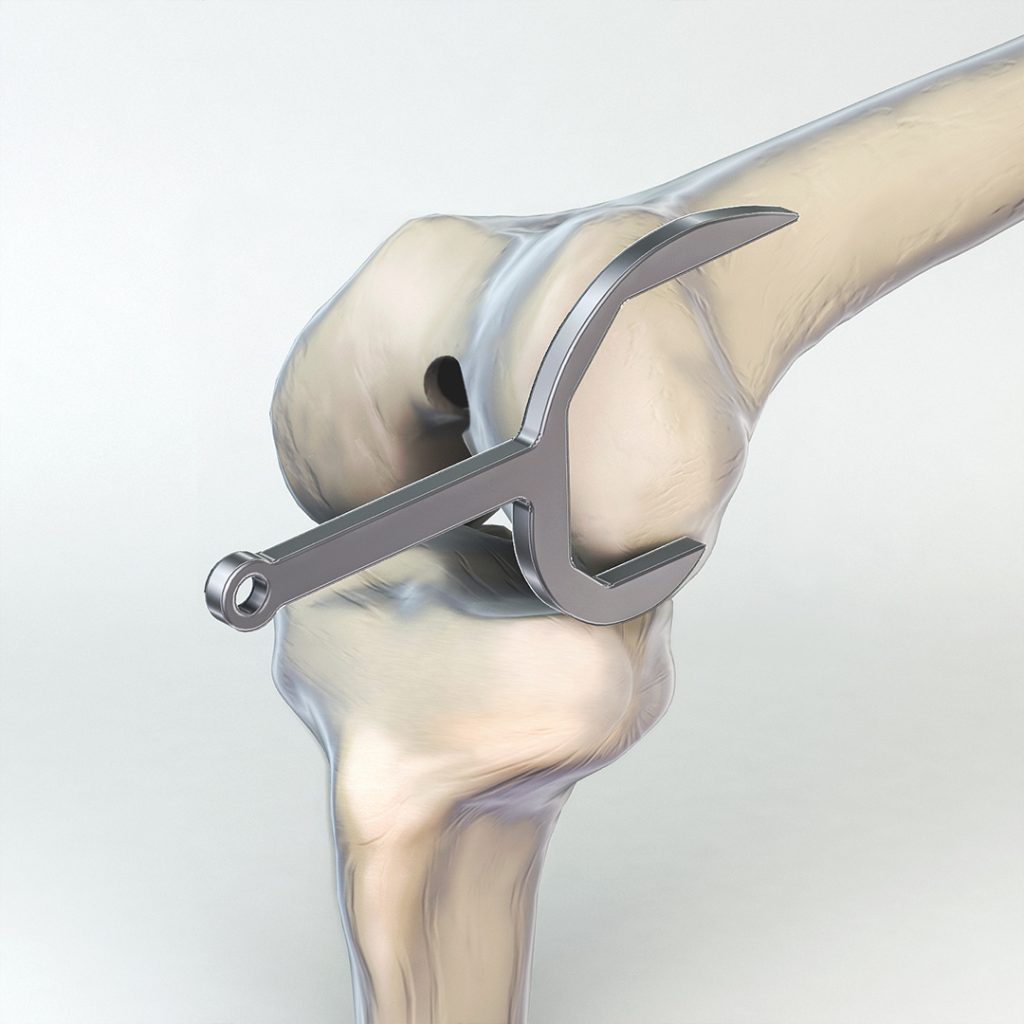 DGO3D Serf Images 3D Prothèse Médicale 3